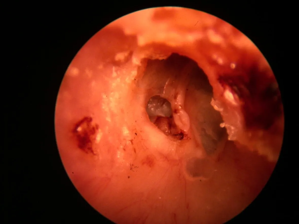 Cavità auricolare infiammata