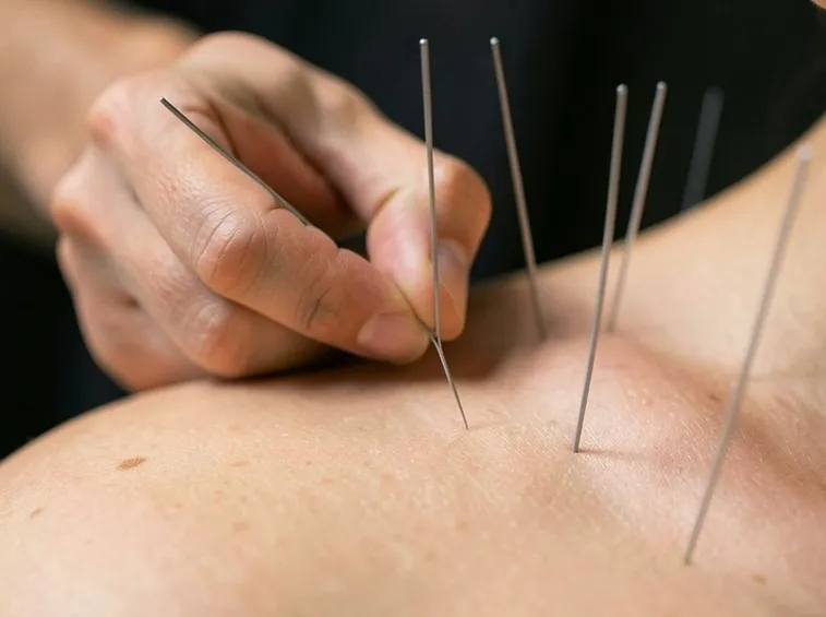 La tecnica dell'agopuntura