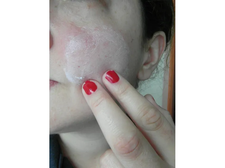crema cicatrici