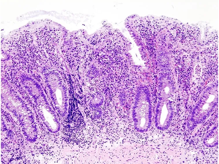 Intestino infiammato al microscopio