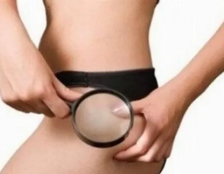 cellulite
