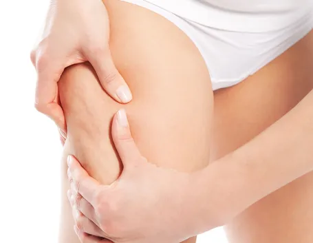 cellulite