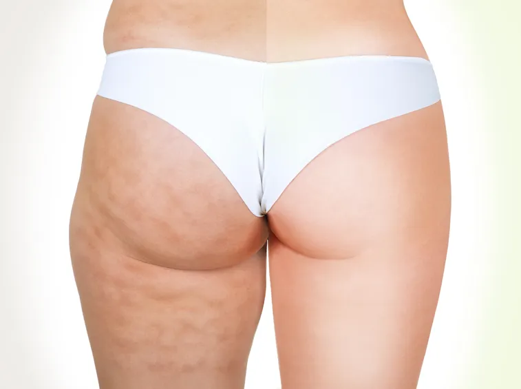 cellulite