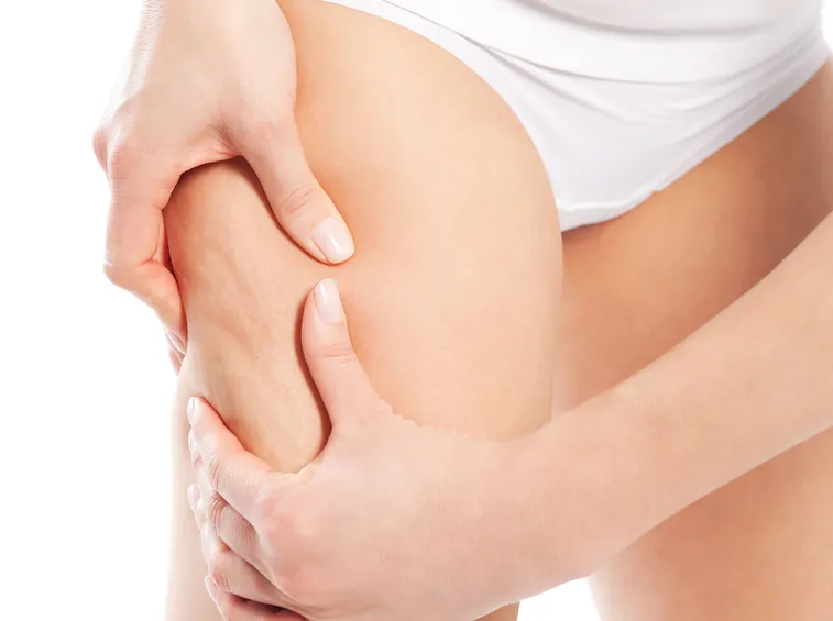 cellulite