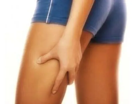 cellulite