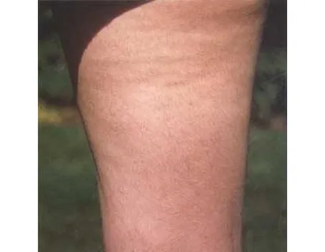 cellulite