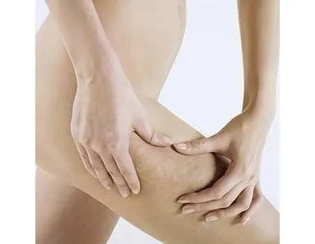 cellulite