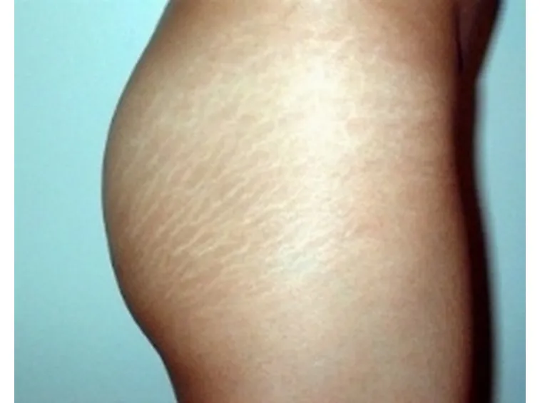 smagliature glutei
