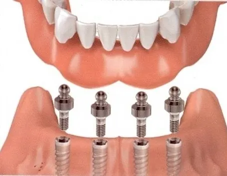 impiantologia dentale 