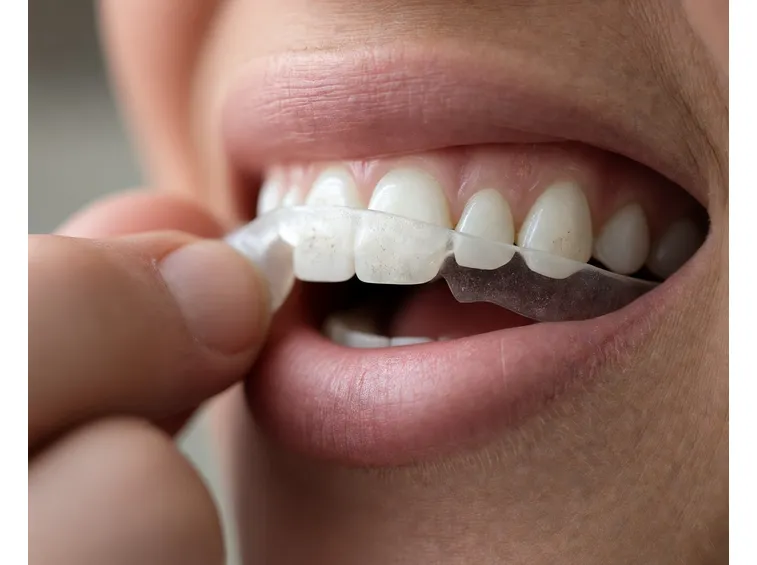 malocclusione 