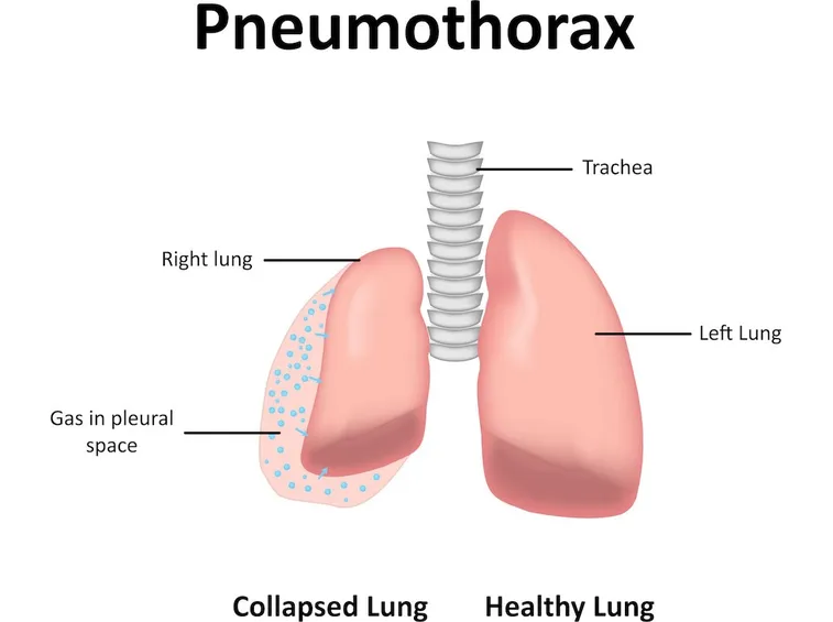 Pneumotorace