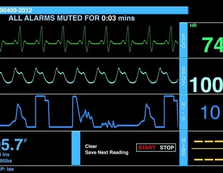 Parametri cardiaci su ecg