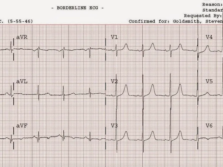 ECG paziente ischemico
