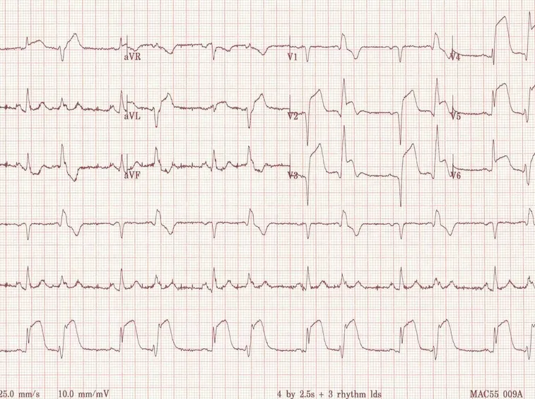 Tracciato elettrocardiografico di infartuato
