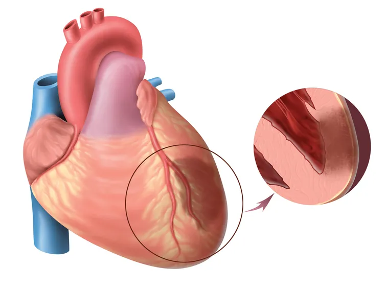 infarto