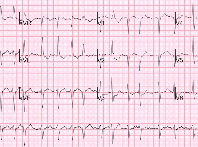 Esempio di ecg cardiaco