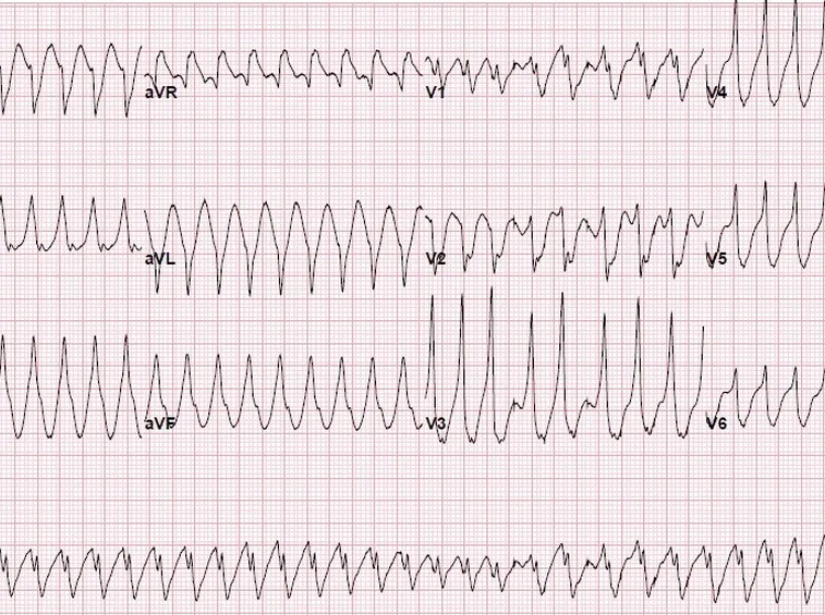 Fibrillazione atriale