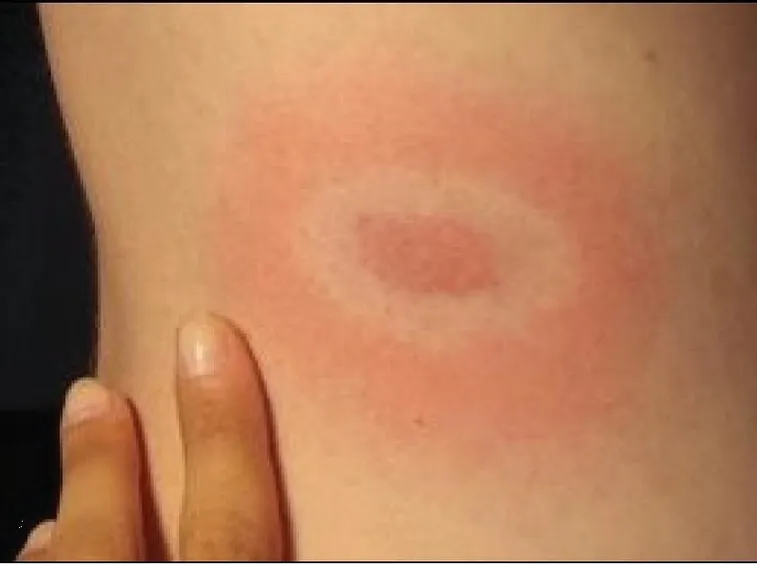 Eritema della Malattia di Lyme