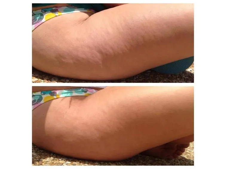 Cellulite prima e dopo il trattamento