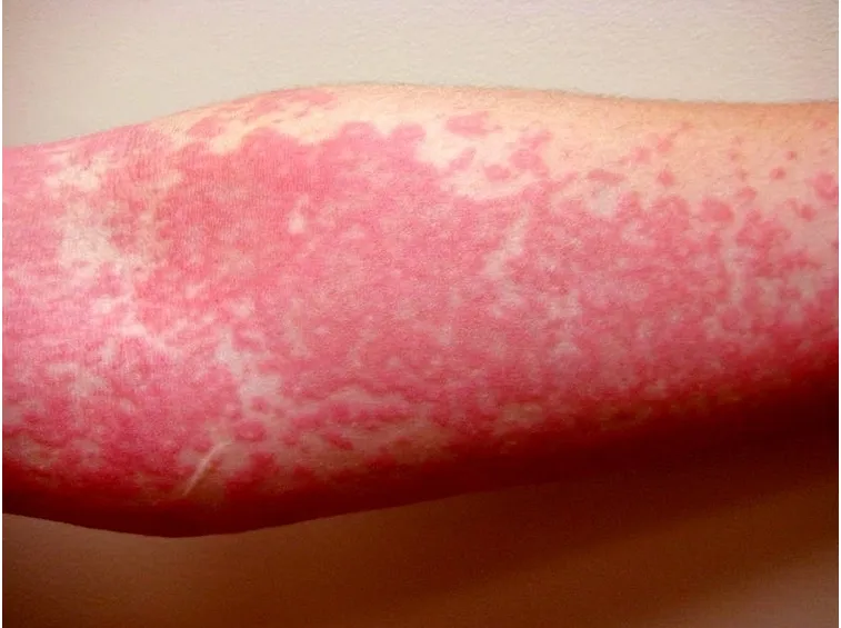 Orticaria.