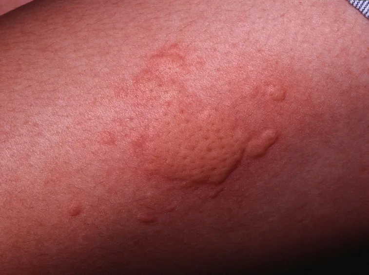 Pomfi da orticaria.