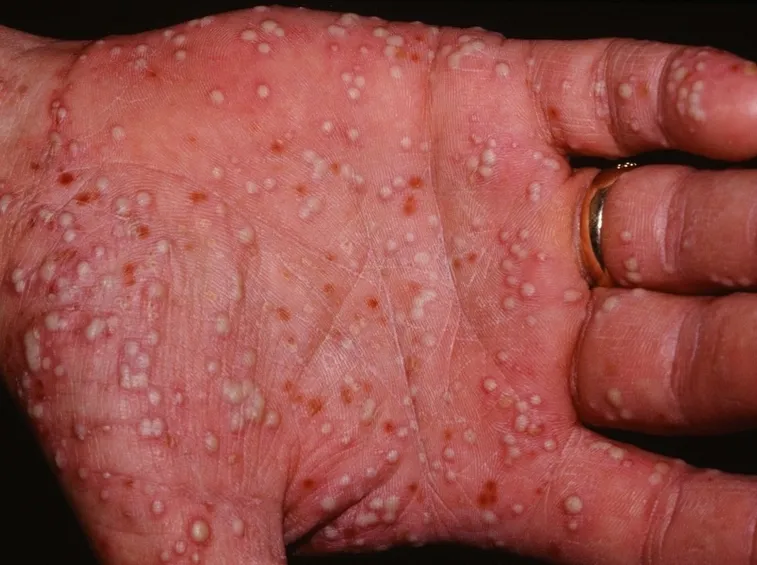 Psoriasi pustolosa palmare
