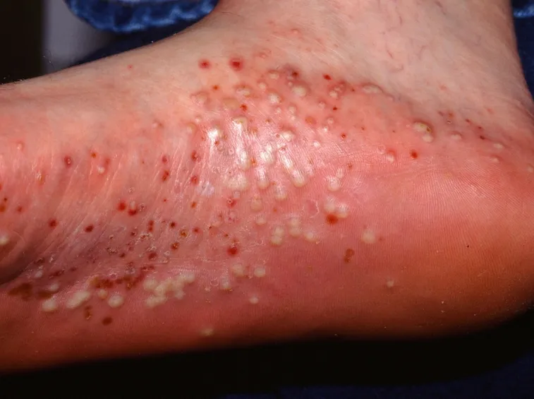 Psoriasi pustolosa plantare
