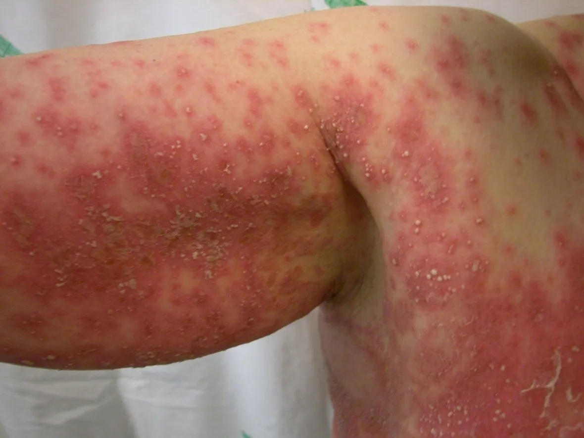 Un caso di psoriasi pustolosa
