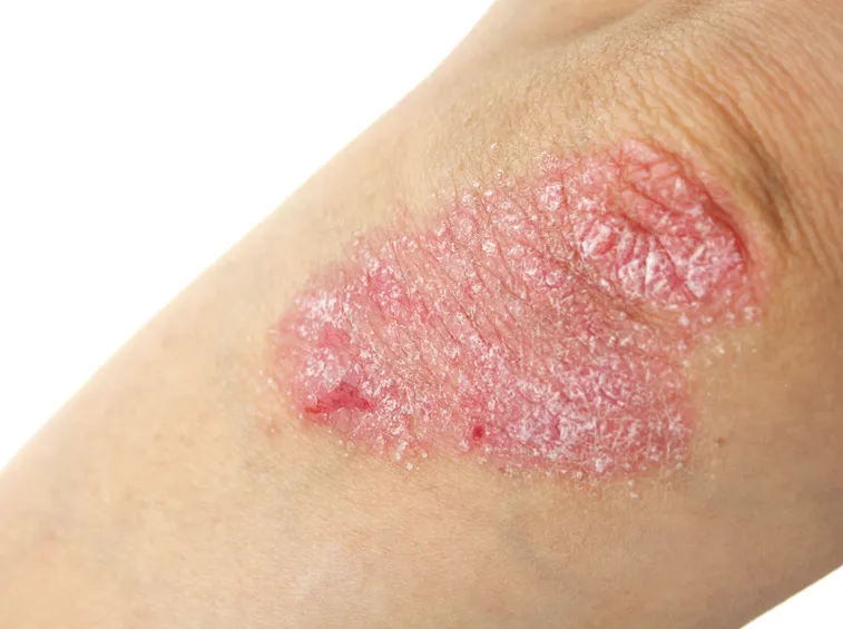 psoriasi postulosa