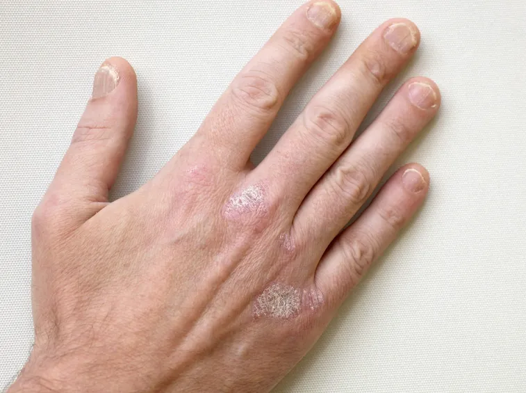 psoriasi