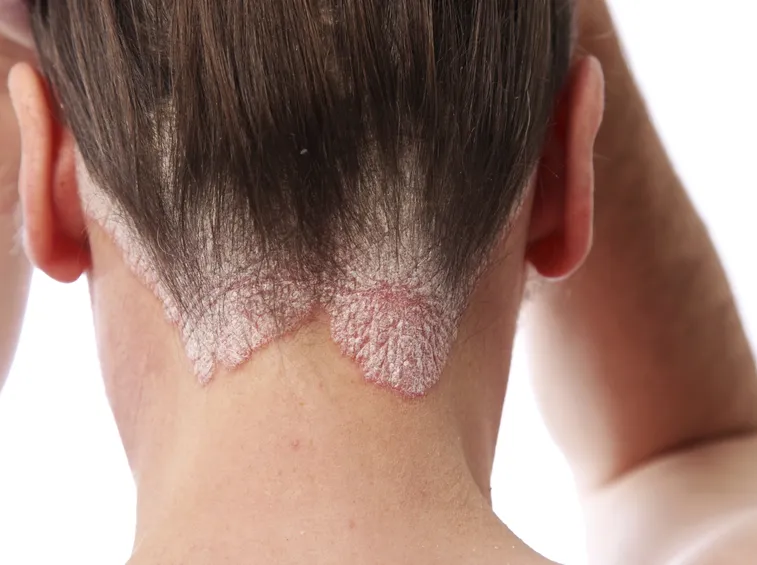 psoriasi
