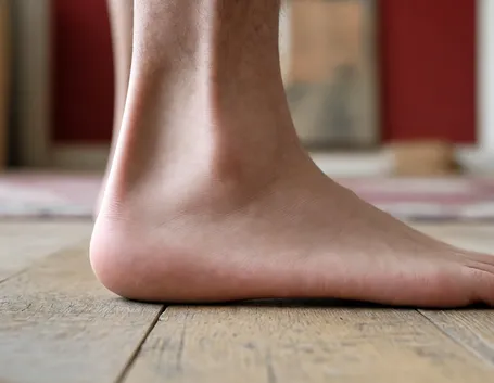 Il tipico piede piatto