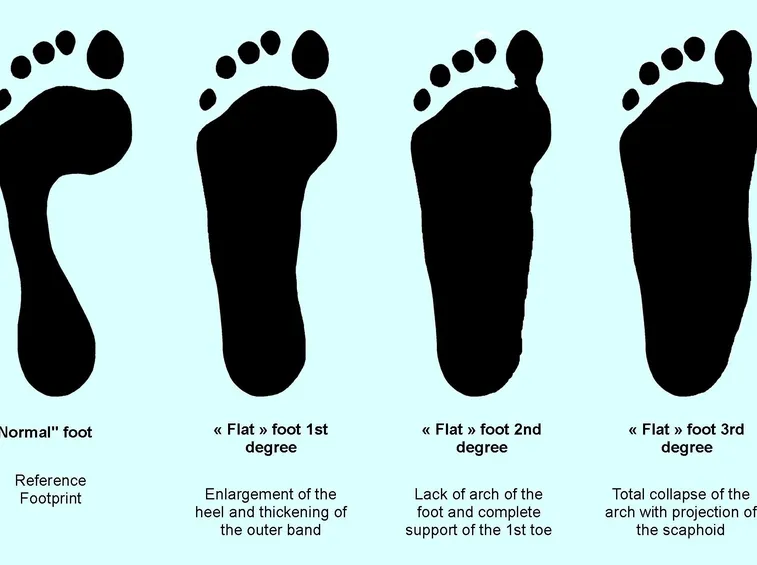 Impronta normale e di piedi piatti
