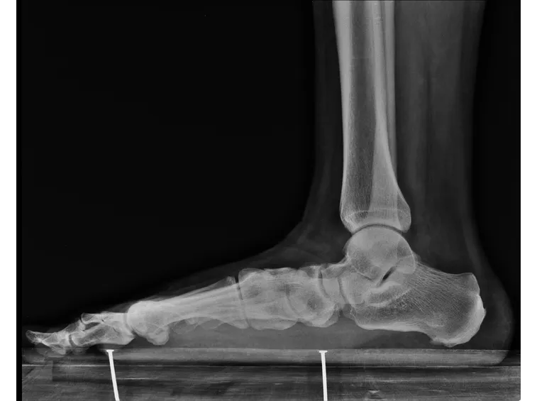 Radiografia di piede piatto