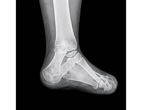 Radiografia di spina calcaneare