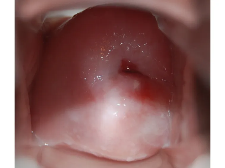 Colposcopia cervice uterina