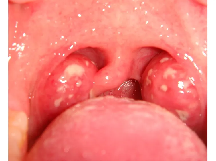 Esempio di mononucleosi infettiva