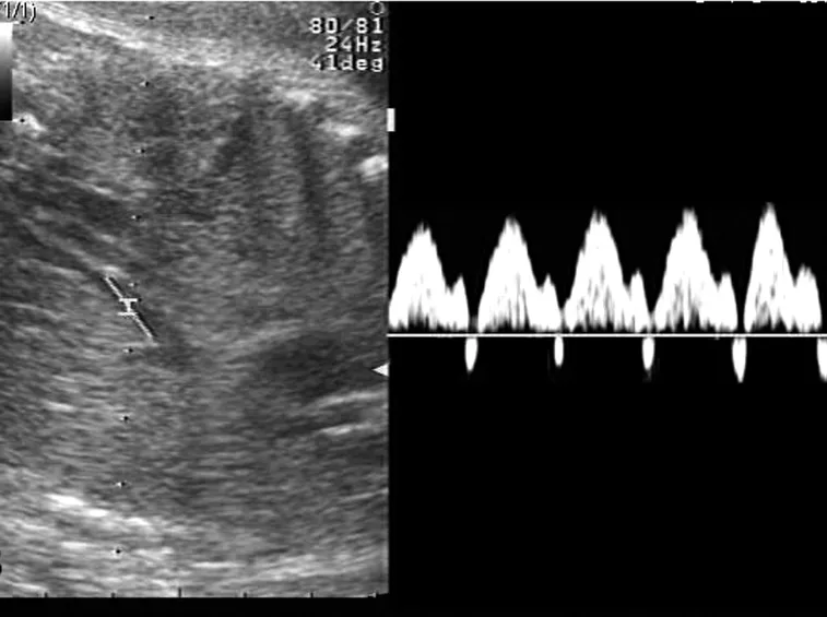 Flussimetria della vena cava inferiore