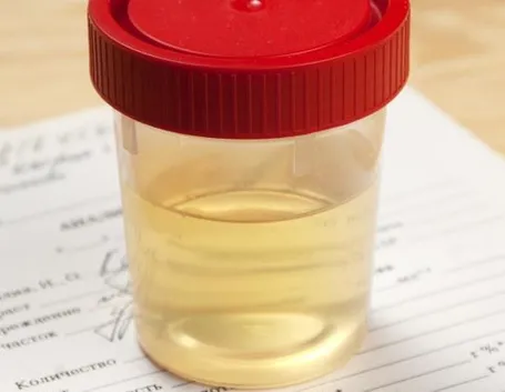 Sangue nelle urine