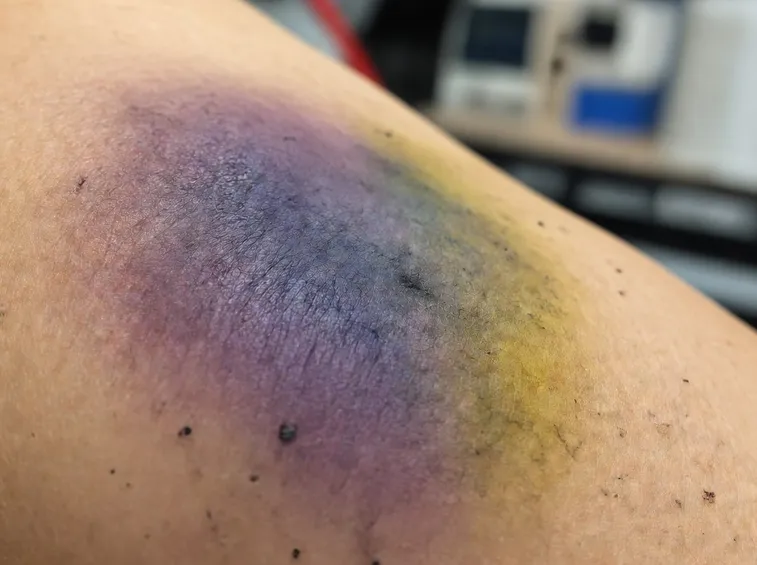 Ematoma in paziente emofiliaco