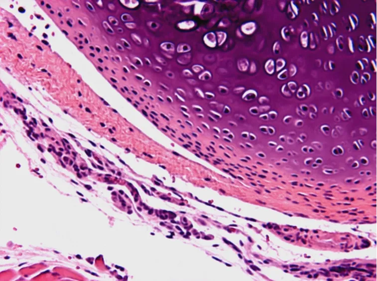 Infiltrazioni in malattia autoimmune