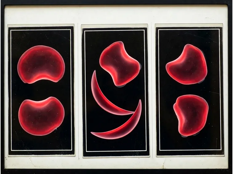Eritrociti anemia falciforme
