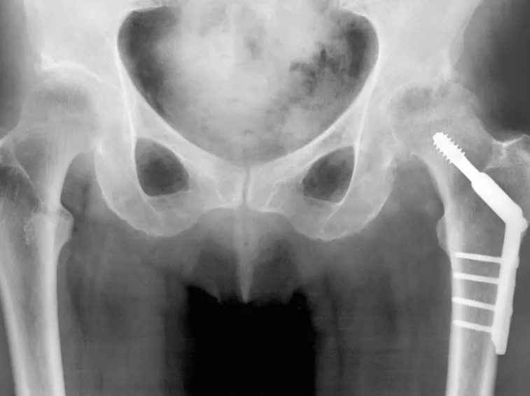 Radiografia al femore