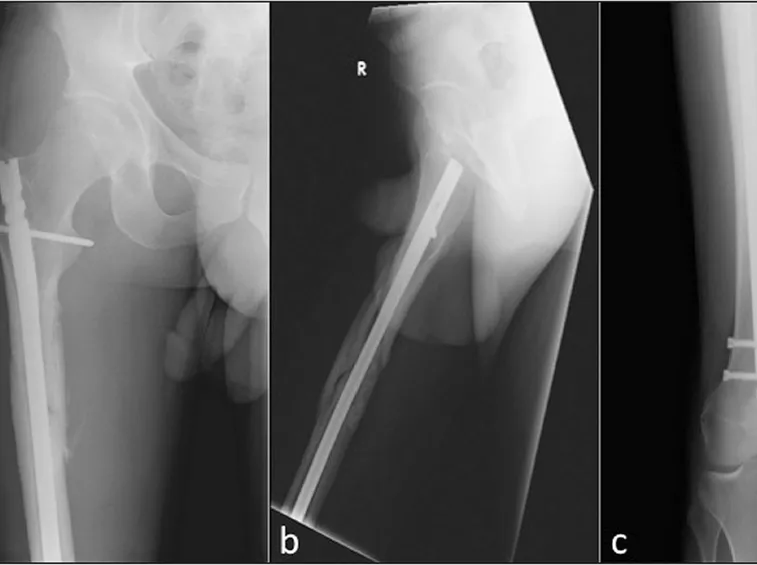 Radiografia femore rotto