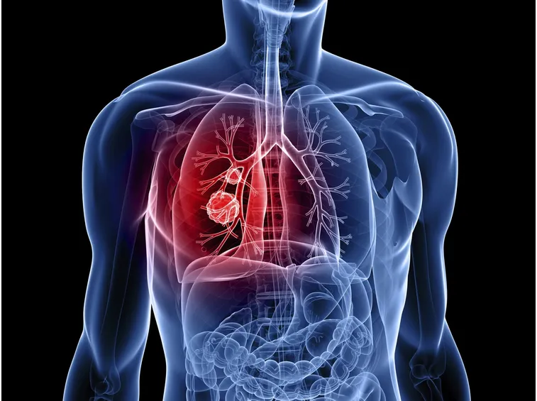 Il mesotelioma provoca la pleurite