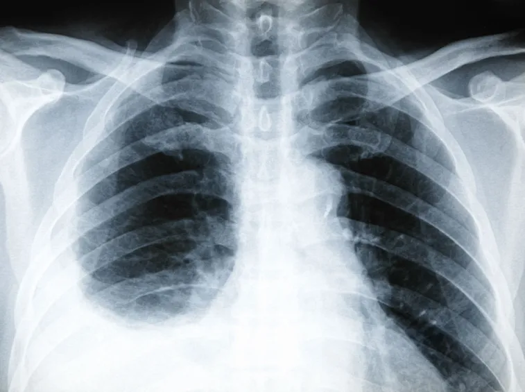 Lastra radiografica di pleurite
