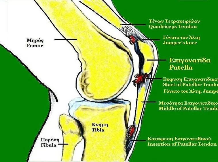 Punti di infiammazione del tendine