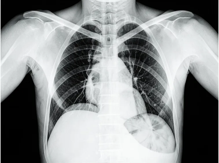 Radiografie per problemi polmonari