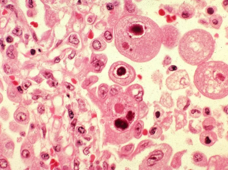 Cellule infiammate dei polmoni
