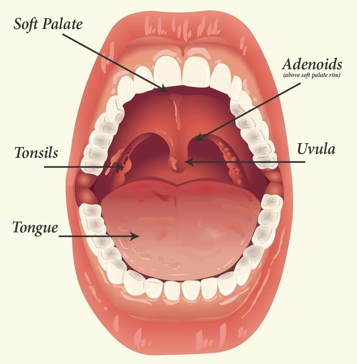 Tonsille adenoidi